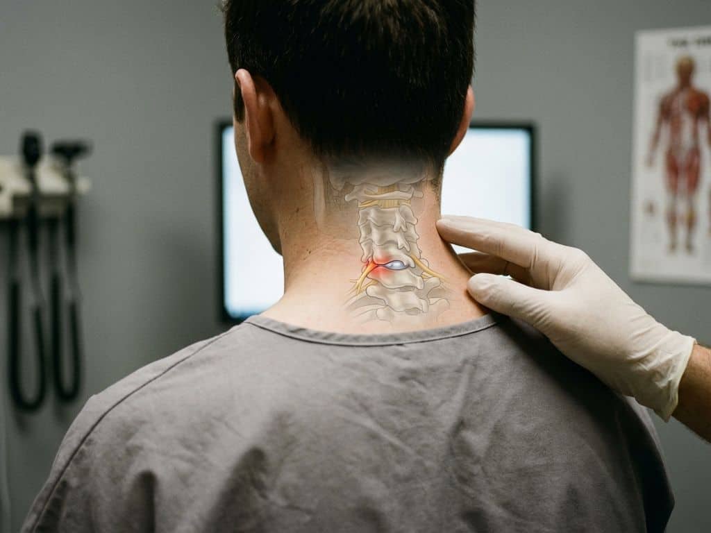 Cervicale wervelkolom met uitpuilende tussenwervelschijf die op zenuwweefsel drukt, gezien vanaf de achterkant van de nek